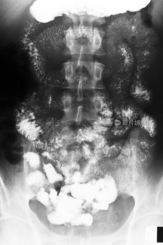人体肠胃的x光片