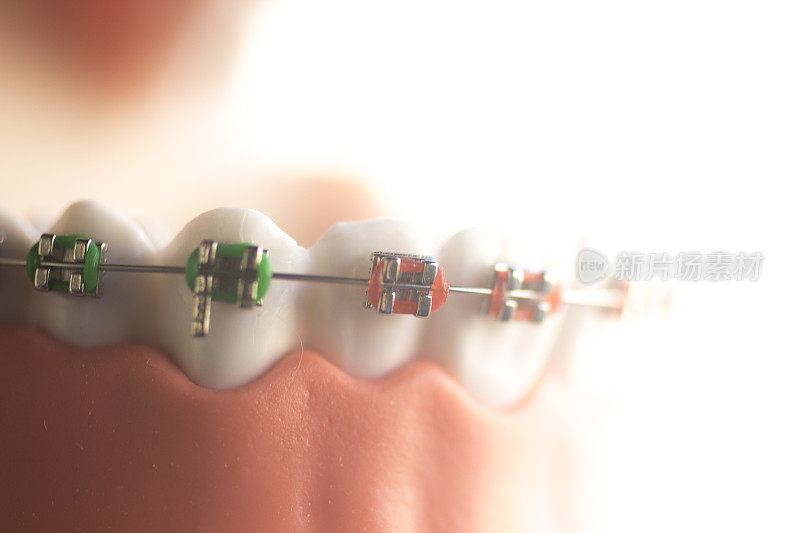 美容牙科正畸牙科金属丝牙托槽教学学生模式。