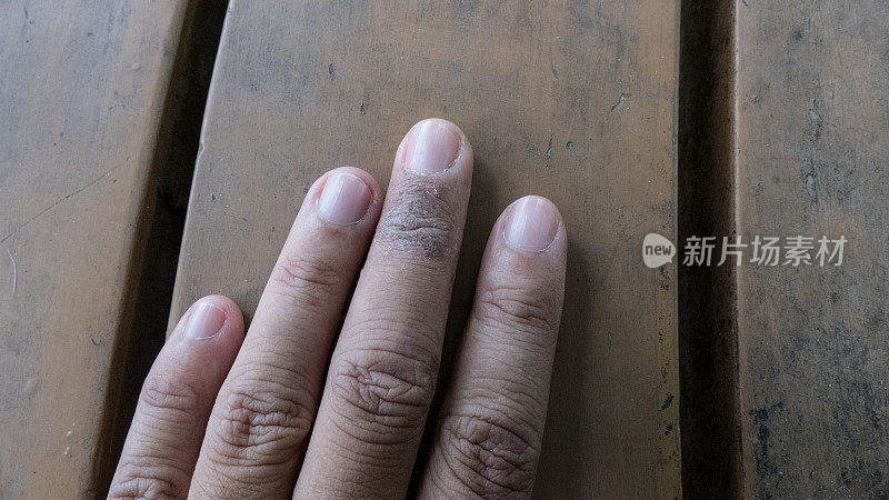 寻常型银屑病，真菌，手指湿疹。皮疹，干燥皮肤的皮肤病
