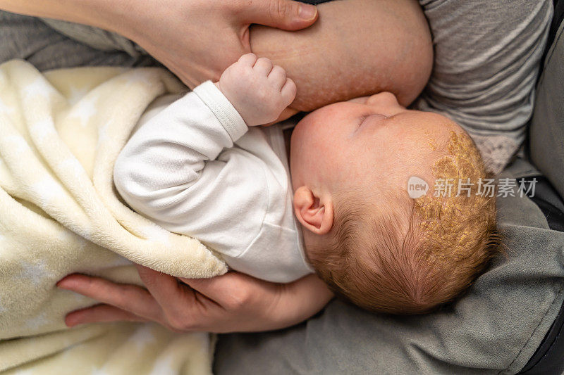婴儿有皮肤问题摇篮帽脂溢性皮炎吃了母亲的母乳喂养
