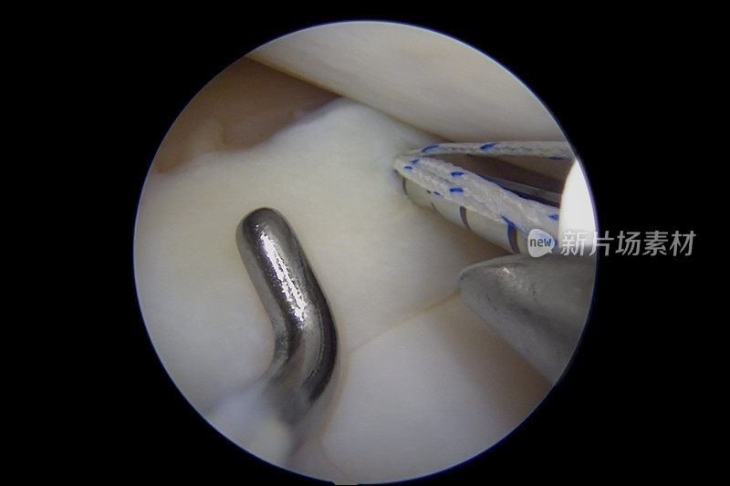 膝关节半月板全内修复的关节镜视图