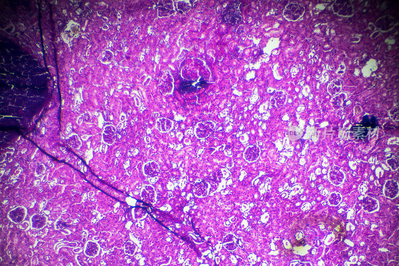 显微镜下急性肾盂肾炎活检标本