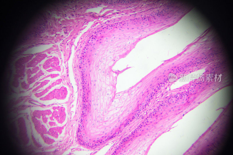 显微镜下呈层状鳞状上皮