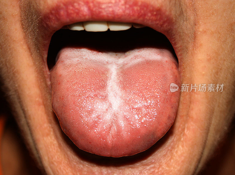 舌念珠菌病。白色涂层。鹅口疮。