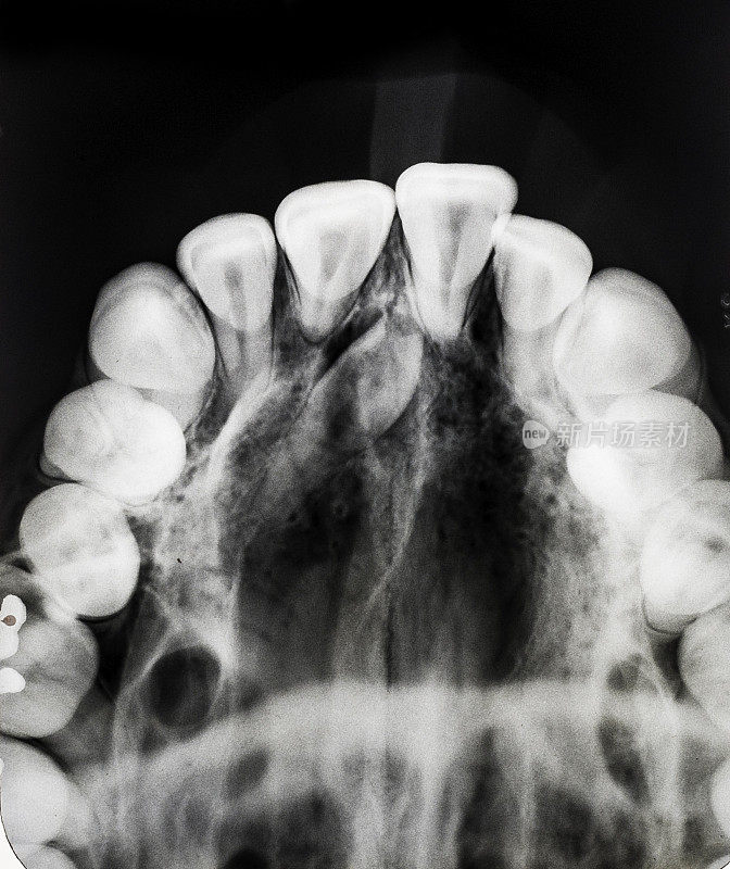 多齿症是一种情况，有多余的牙齿，或牙齿出现在正常数量的牙齿。上颚靠近中线多生一颗牙。