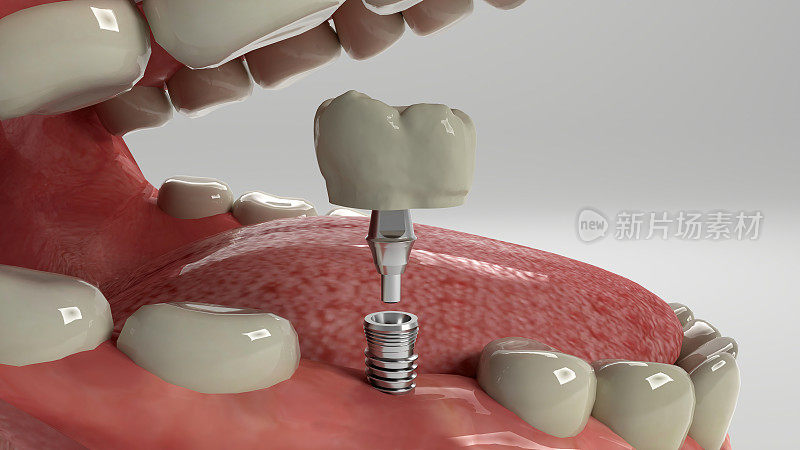牙齿植入安装