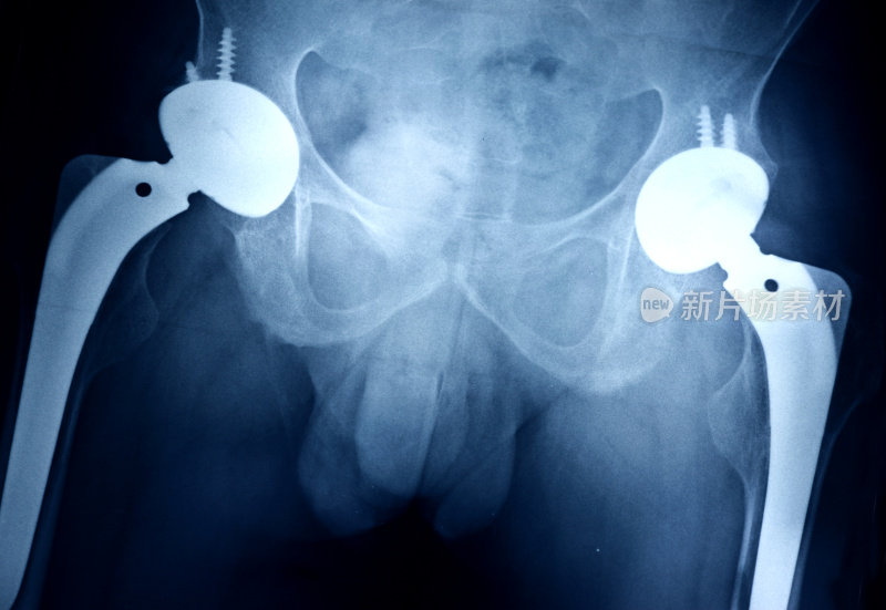 骨盆x光检查双侧全髋关节置换术