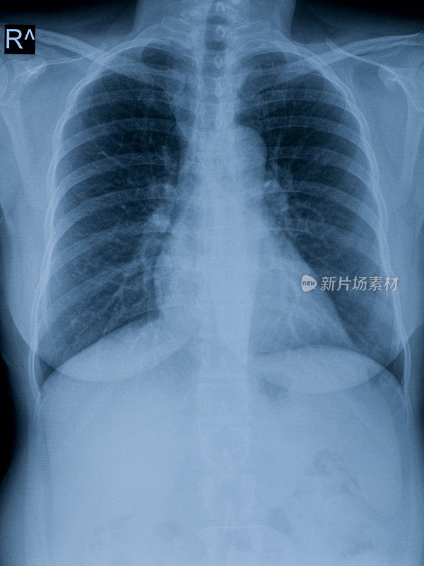 胸部x线照片