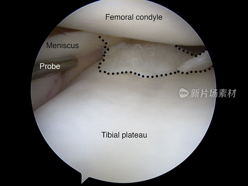 膝关节内侧半月板撕裂的关节镜观察