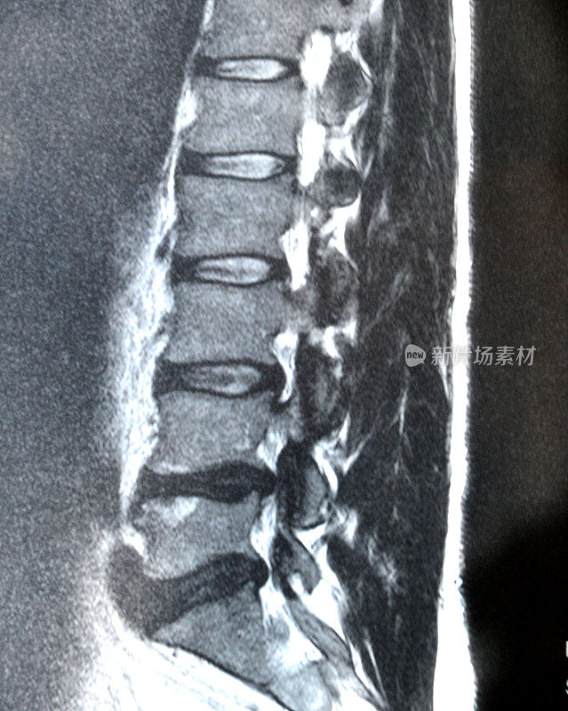 脊柱MRI扫描显示椎间盘突出