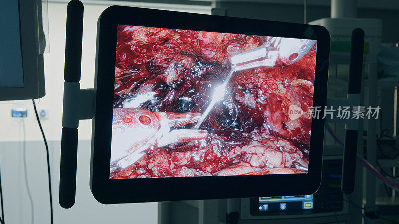 缝制阶段。医疗机器人。腹腔镜腔内手术监视器的特写镜头，腹腔