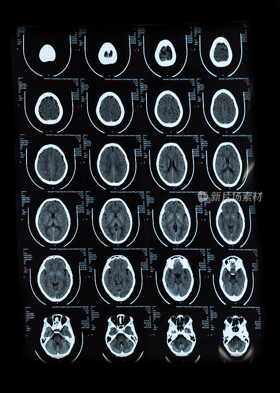 头部CT扫描片