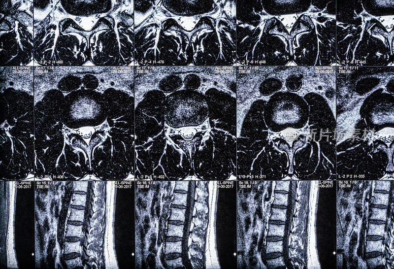 人脊柱和脊椎的MRI扫描