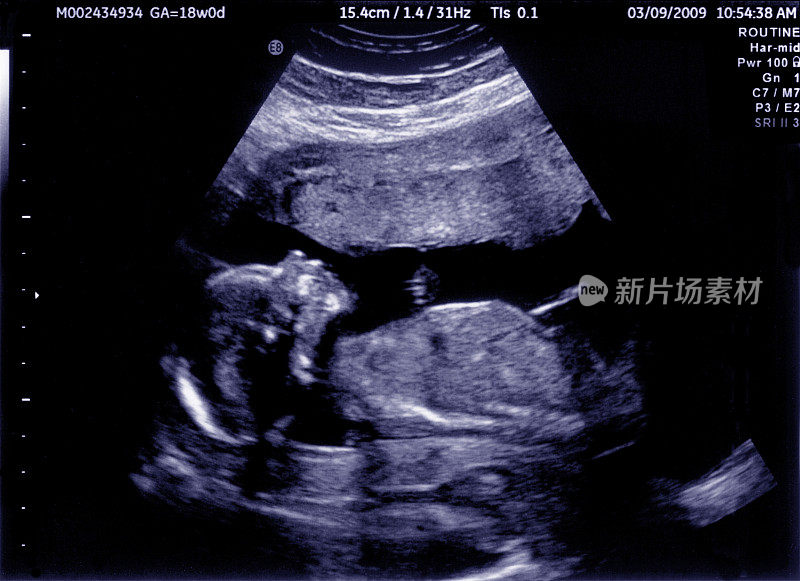 胎儿超声图像