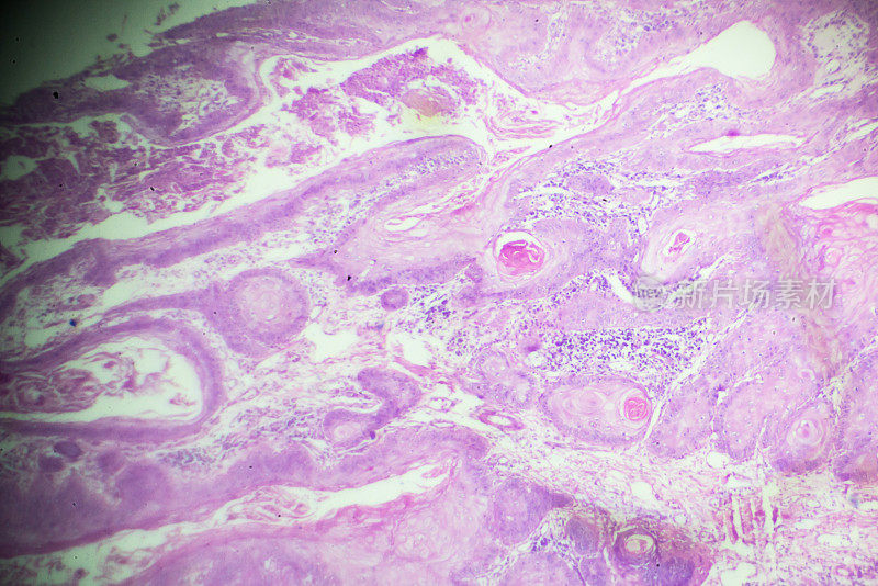 鳞状细胞癌显微镜下