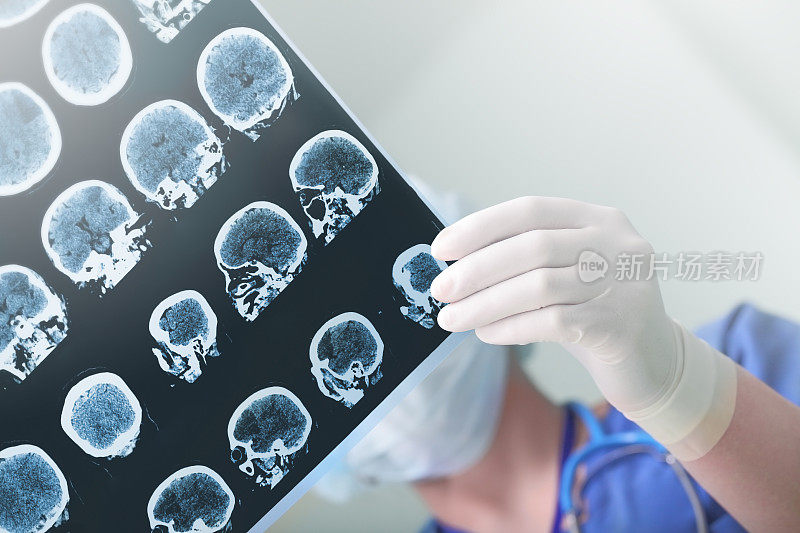 医学专家研究了病人的脑电图情况