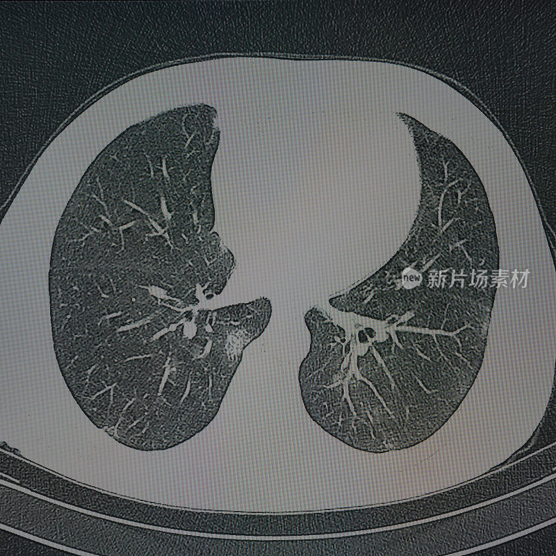 计算机显示器上的人肺胸部Ct图像