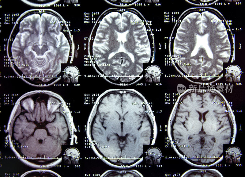 头部MRI扫描的近景。