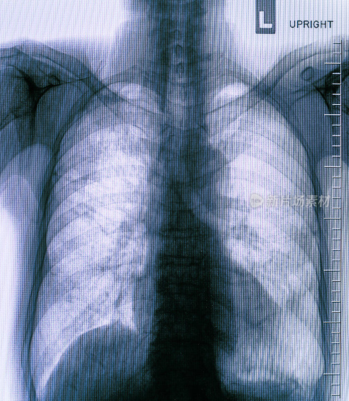 肺炎测试扫描，现代x射线照相细节
