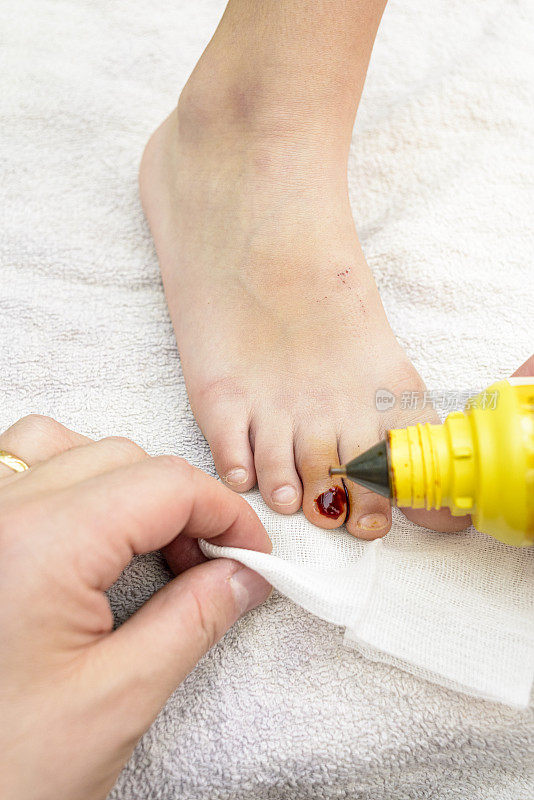 孩子脚趾甲受伤的细节。