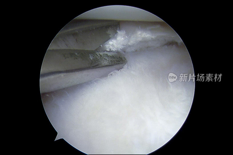 膝关节骨性关节炎和退行性半月板撕裂的关节镜观察