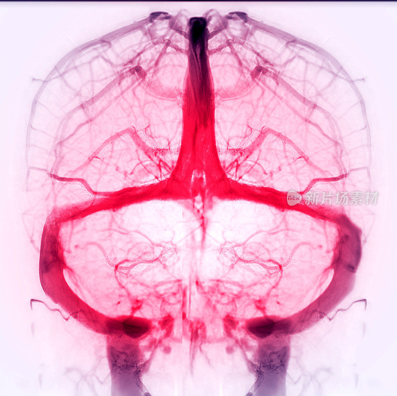 脑静脉造影诊断脑静脉血栓形成