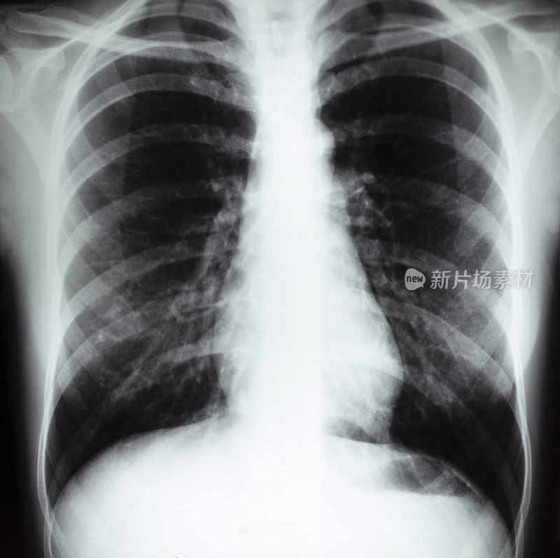 人体胸部的x光影像