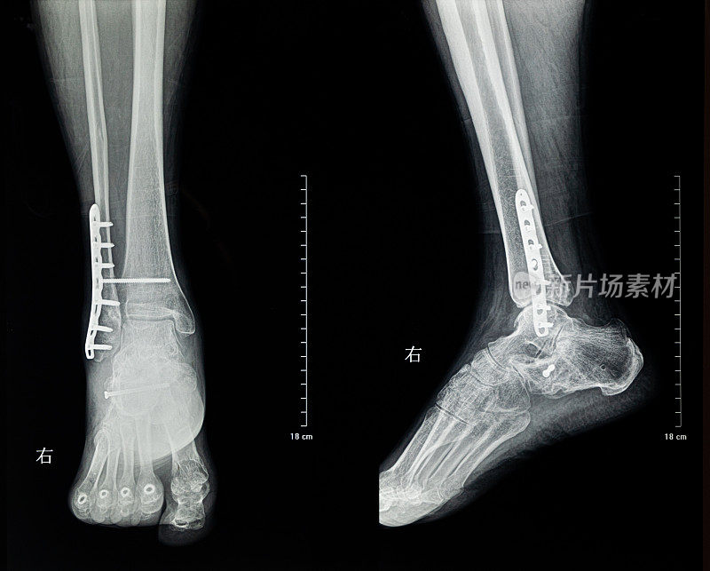 人体腿部和足部x光片