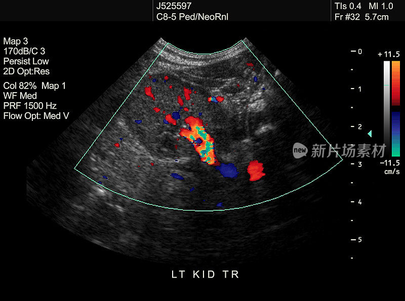 新生儿肾脏图像，血流正常