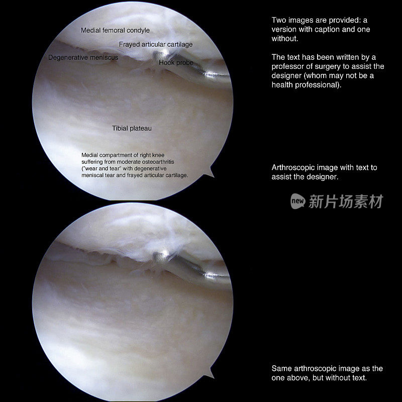 中度骨关节炎患者膝关节镜检查