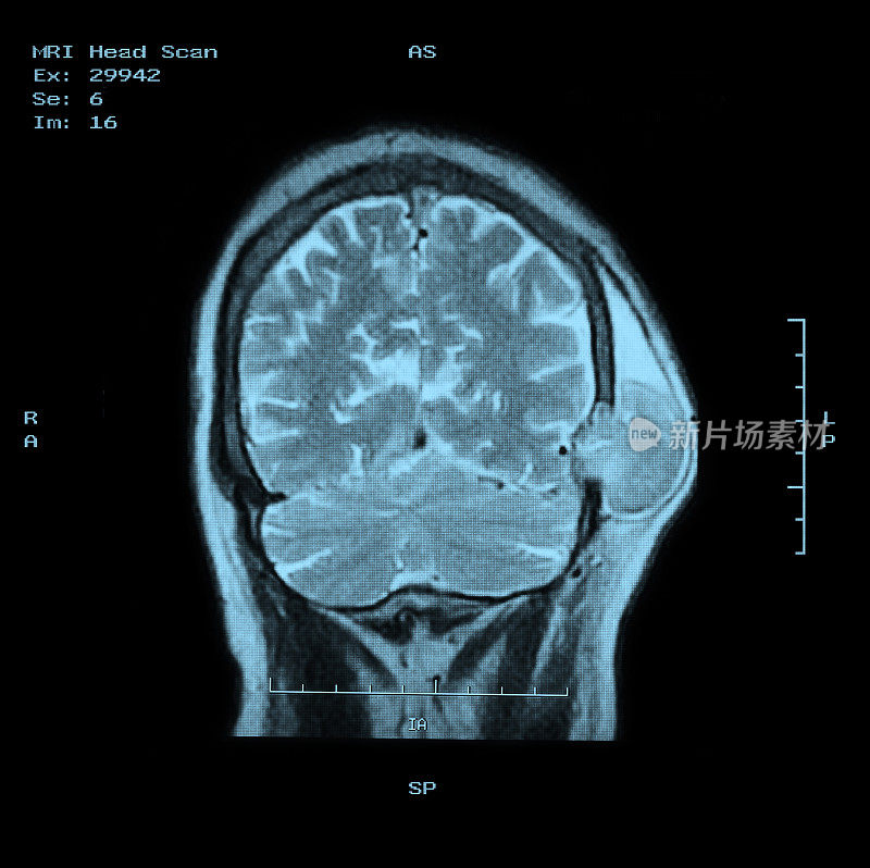 MRI头部扫描后视图，肿瘤清晰
