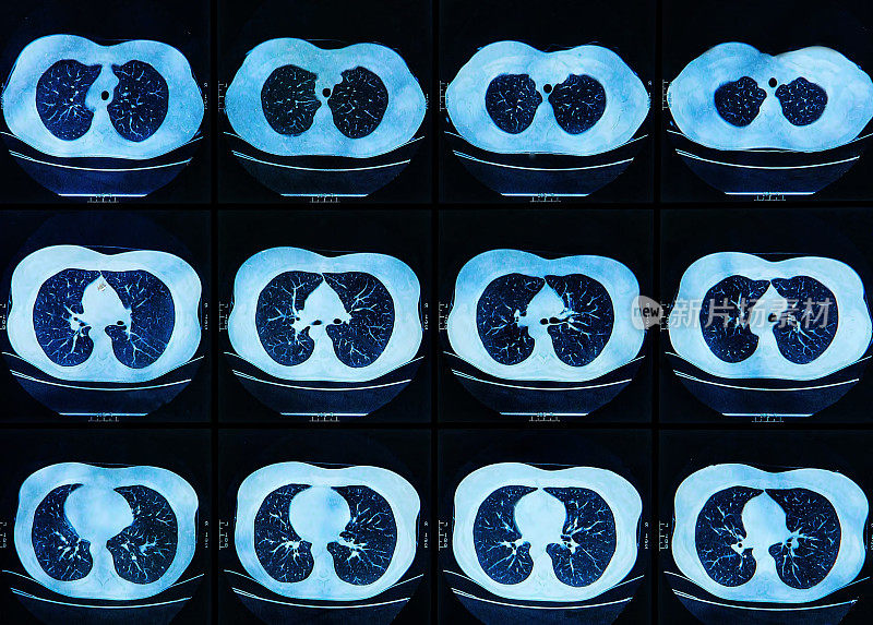 磁共振成像扫描人类肺部
