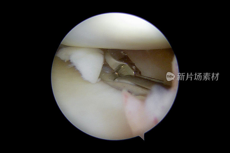 右膝关节内侧室半月板撕裂的关节镜照片