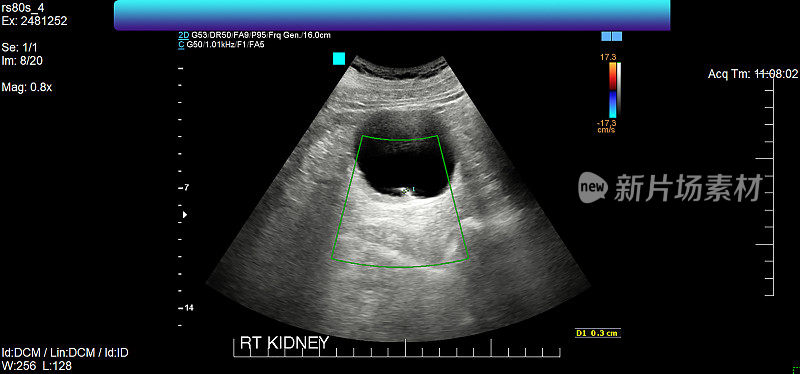 右肾超声