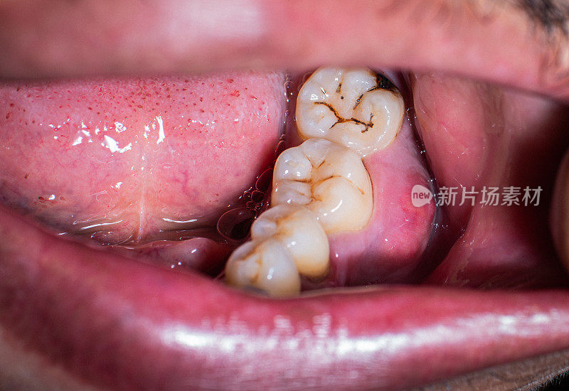 口腔和牙齿健康状况不佳、蛀牙、牙龈疾病和牙龈肿胀都会导致牙痛。牙齿被染黑，牙菌斑又脏又黄。
