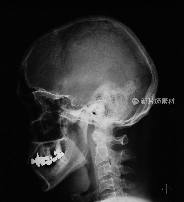 人类颅骨x光片，侧视图