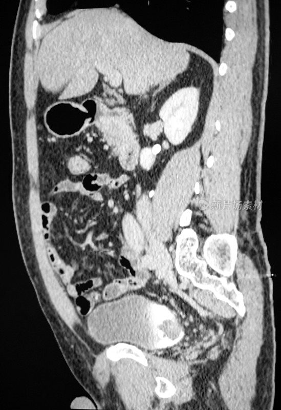膀胱癌的CT影像