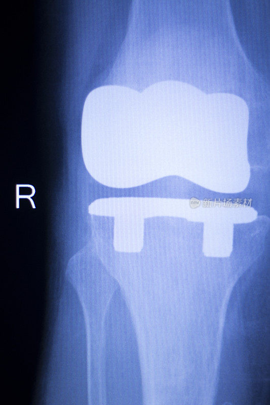 膝关节骨科植入物x线扫描