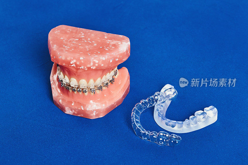 带有金属丝牙套的人类颌或牙齿模型