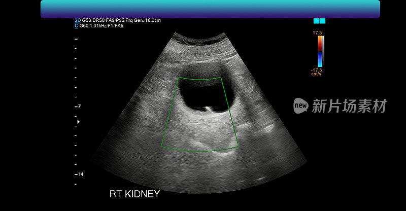 右肾超声