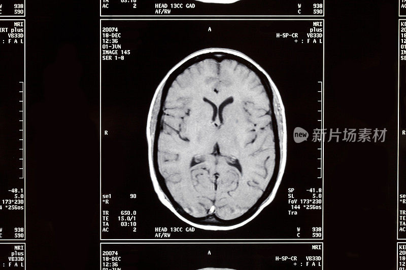 脑部核磁共振电影