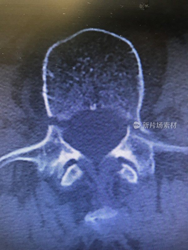 CT轴位显示腰椎椎弓根骨折