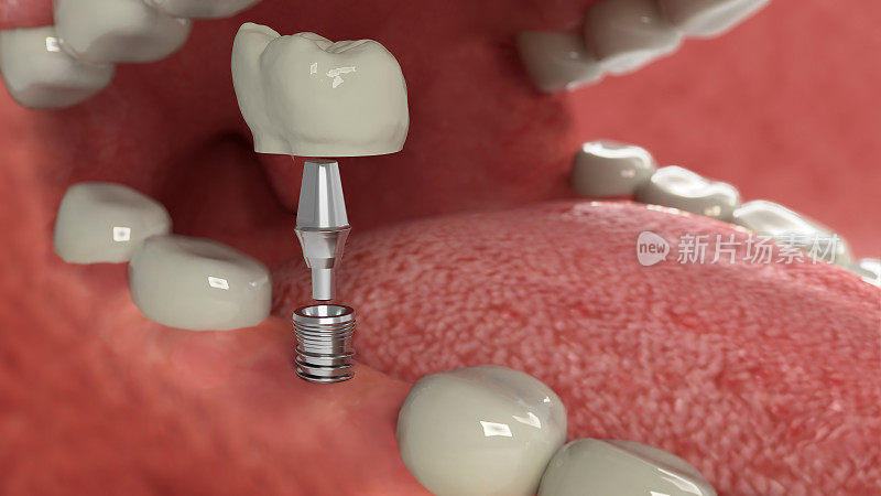 牙科植体安装