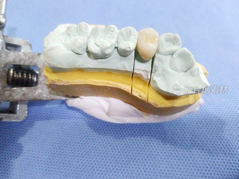 牙科诊所的氧化锆冠