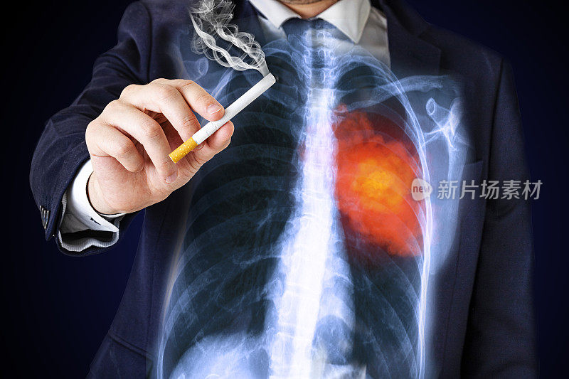 肺癌概念:吸烟男子患肺癌