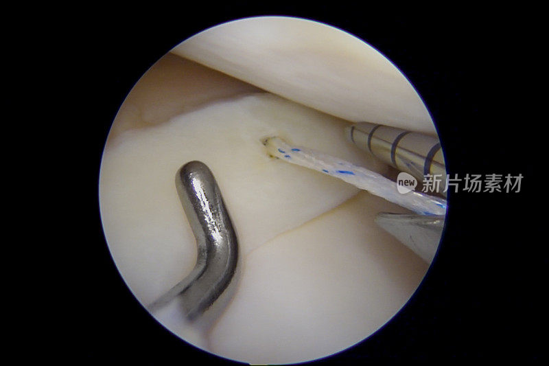 膝关节半月板全内修复的关节镜视图