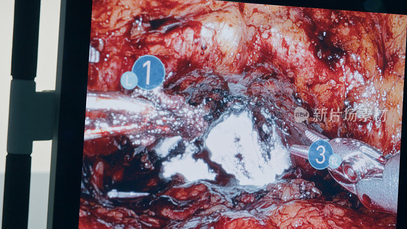 医疗机器人。腹腔镜腔内手术监视器的特写镜头，腹腔