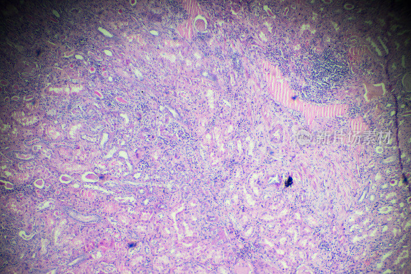 光镜下慢性肾盂肾炎活检