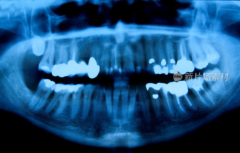 由于蛀牙而有许多填充物的颌骨的x光照片