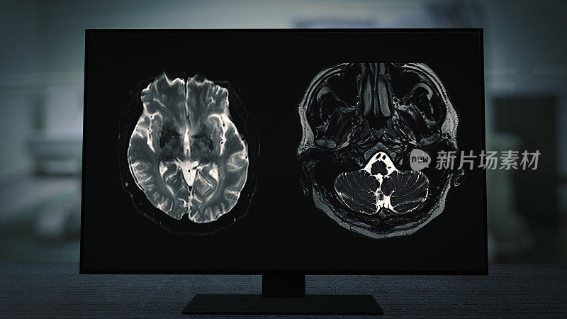 CT脑部扫描图像的磁共振成像(MRI)监视器